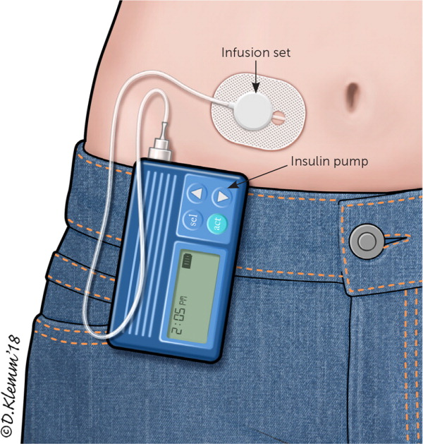 Components Of Insulin Pump Therapy System