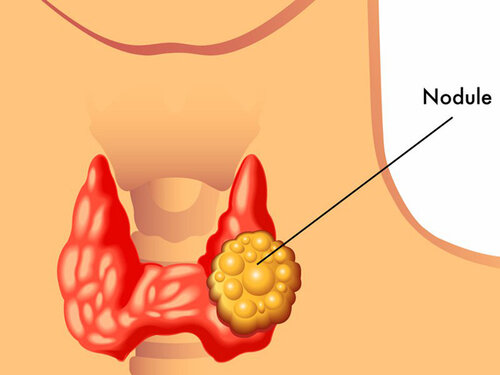 5 Little-Known Thyroid Nodules Warning Signs