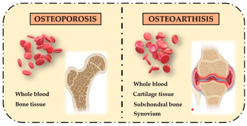Is There A Relationship Between Osteoarthritis And Osteoporosis?