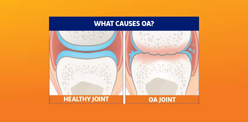 Is There A Relationship Between Osteoarthritis And Osteoporosis?