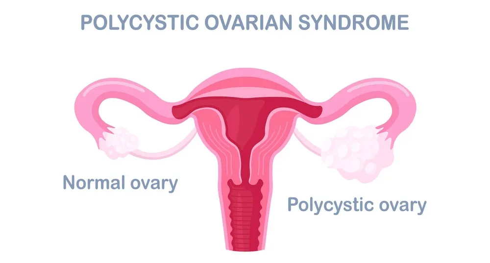Does polycystic ovary syndrome cause diabetes?