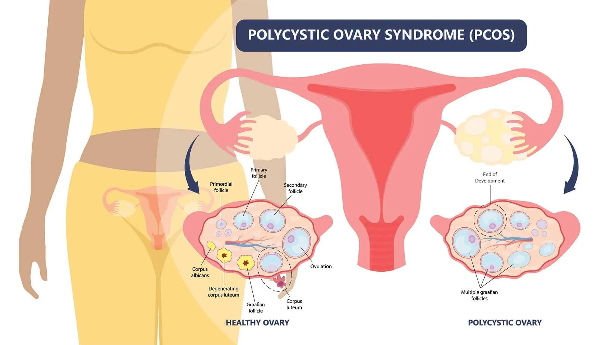 Can the effects of PCOS like Hirsutism be permanently cured?